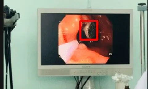 Ngậm đinh trong miệng, người đàn ông 50 tuổi gặp sự cố đáng sợ