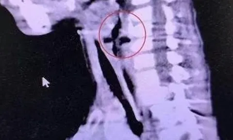 Bé trai 6 tuổi khò khè suốt nhiều tháng, bác sĩ gắp ra thứ "đáng sợ"